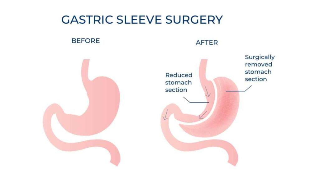 Which Is Better Gastric Sleeve Or Gastric Bypass? - Renovated Me