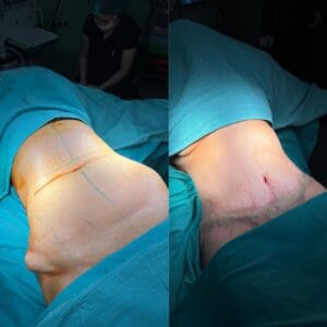 A certified post-op specialist gently administering a manual lymphatic drainage massage on a patient's midsection to reduce swelling and fluid retention after a tummy tuck.