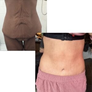 A close-up graphic of a flat, toned female abdomen 12 months post-abdominoplasty, demonstrating the surgical correction of severe abdominal muscle separation.