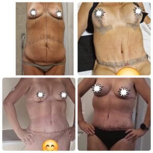 Side-by-side comparison of a female patient’s midsection and bustline before and 6 months after a custom Mummy Makeover package, showing a restored, contoured silhouette.
