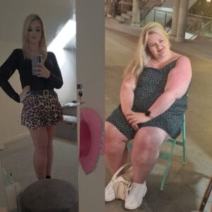 Side profile before-and-after comparison highlighting a patient's drastic reduction in belly fat, improved posture, and increased energy levels post-surgery.