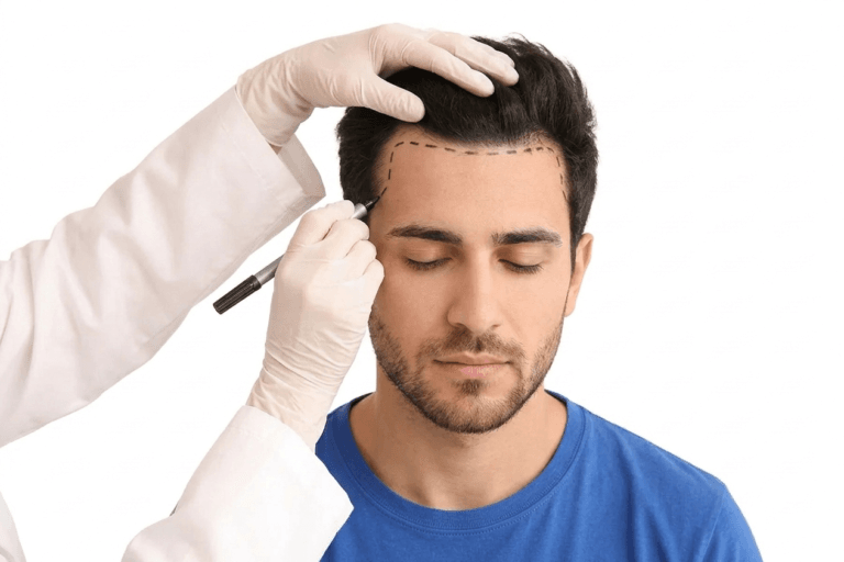 A specialist performing a follicular unit extraction (FUE) hair transplant procedure.