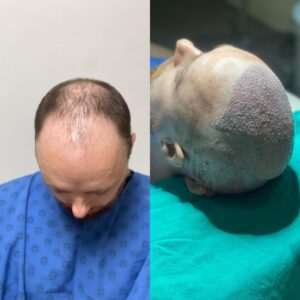 hair transplant before and after