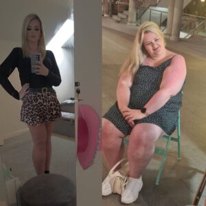 Side profile before-and-after comparison highlighting a patient's drastic reduction in belly fat, improved posture, and increased energy levels post-surgery.