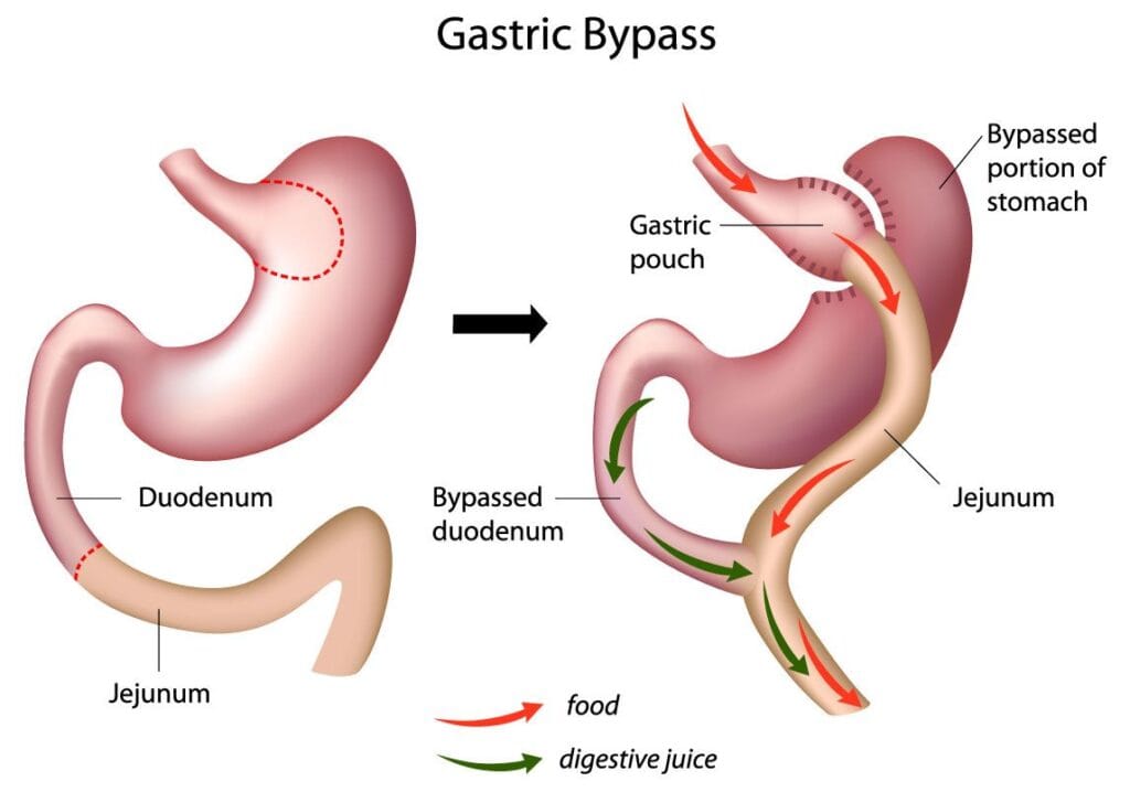is it safe to go abroad fr gastric bypass surgery