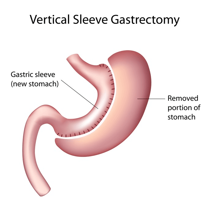gastric sleeve surgery in Turkey